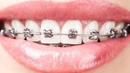 braces