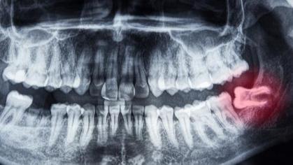 dental x-ray