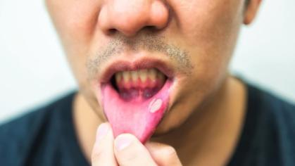 Oral ulcer